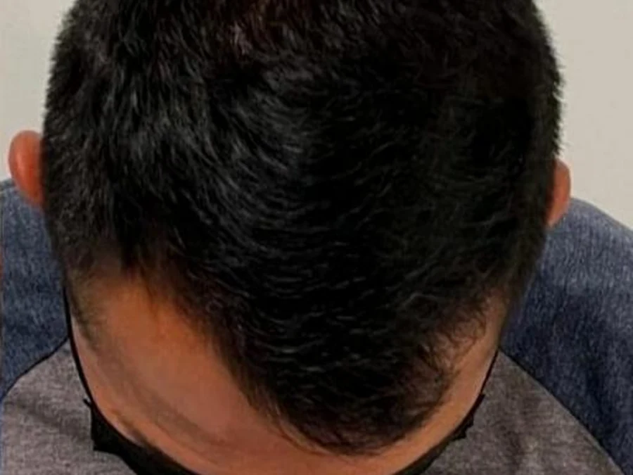 After treatment