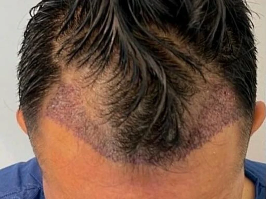 Before treatment