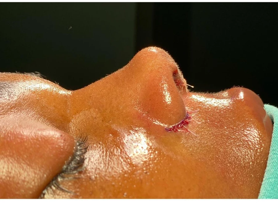 After treatment