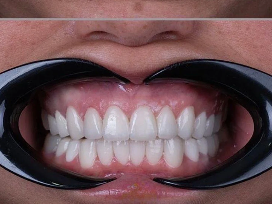 After treatment