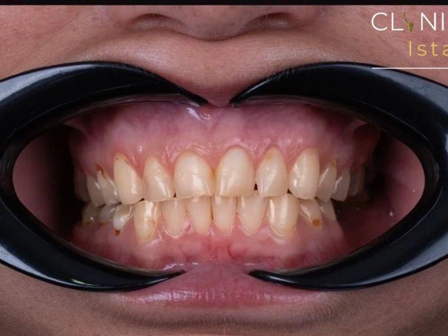 Before treatment